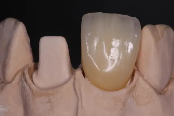 Corona anterior junto a su muñón preparado en el modelo de escayola