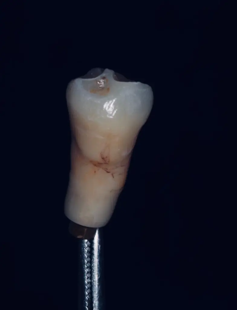Corona individual de cerámica estratificada sobre su vástago