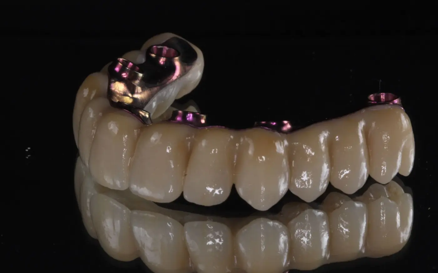Prótesis híbrida superior sobre implantes con estructura de titanio, reflejada sobre fondo negro